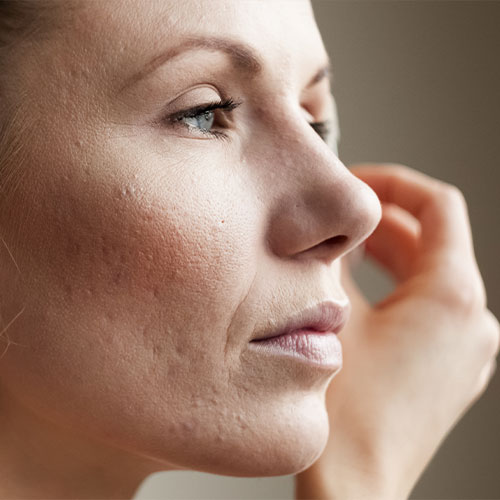 Quelles sont les solutions naturelles face à l'acné ?